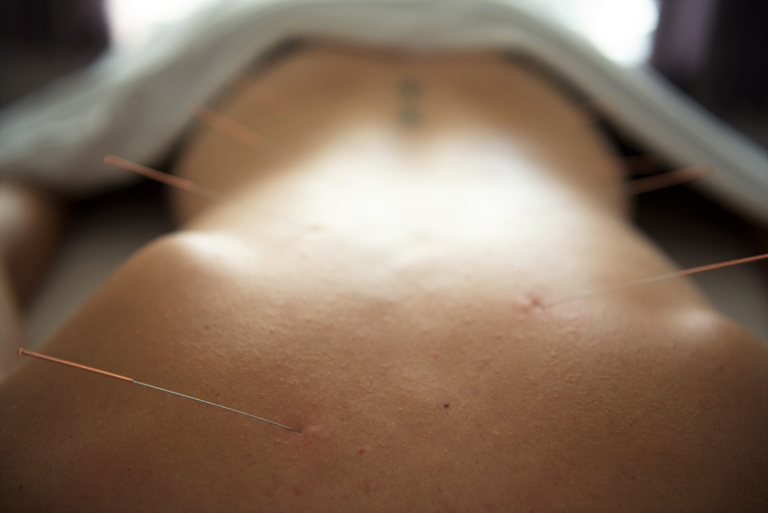 acupuncture lanaudière